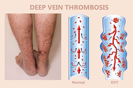 arterial thrombosis vs venous thrombosis